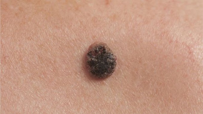 Skin Cancer Or Age Spot On Face / PLEASE HELP ROUGH BUMPY SKIN | Penis Disorders | Forums : Lines, wrinkles, and dark spots are all telltale signs of aging.