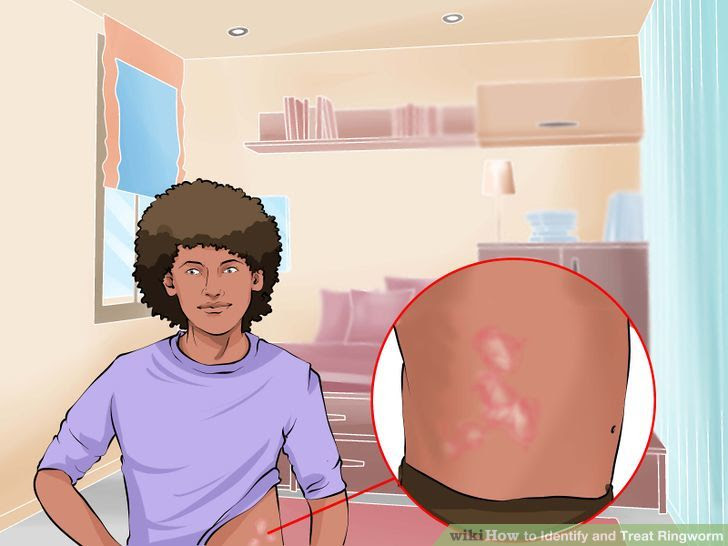 Identify and Treat Ringworm Step 1.jpg