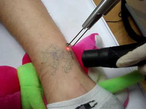 October 12th, 2010 at 09:37 pm / #laser tattoo removal cost #wrecking ball October 12th, 2010 at 09:37 pm / #laser tattoo removal cost #wrecking ball