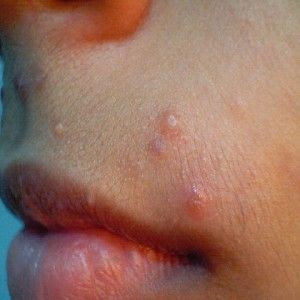 Natural Cure For Molluscum Contagiosum  Home remedies  Pinterest