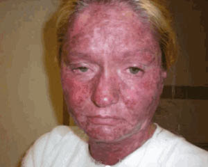 Can Hep C Cause A Rash