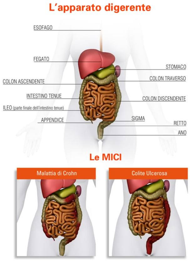 Il Morbo di Crohn dalla parte del paziente