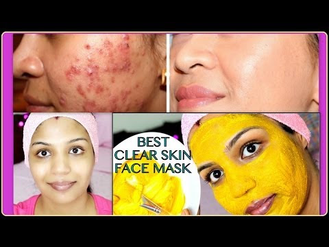 Best Acne Treatment How to Get Flawless Skin Skin Care Routine