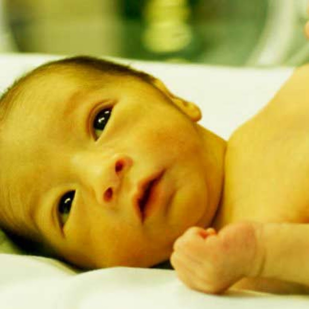 Kesehatan Anak - Kapan Bayi Kuning Dianggap Bahaya 
