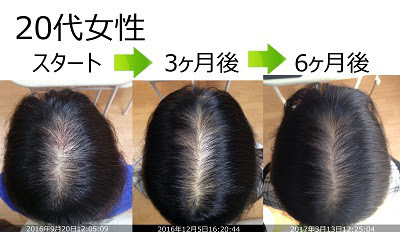 女性の薄毛治療 発毛実績 熊本スーパースカルプ発毛センターくまなん院