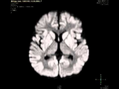 Harga Cord Blood Treatment For Cerebral Palsy