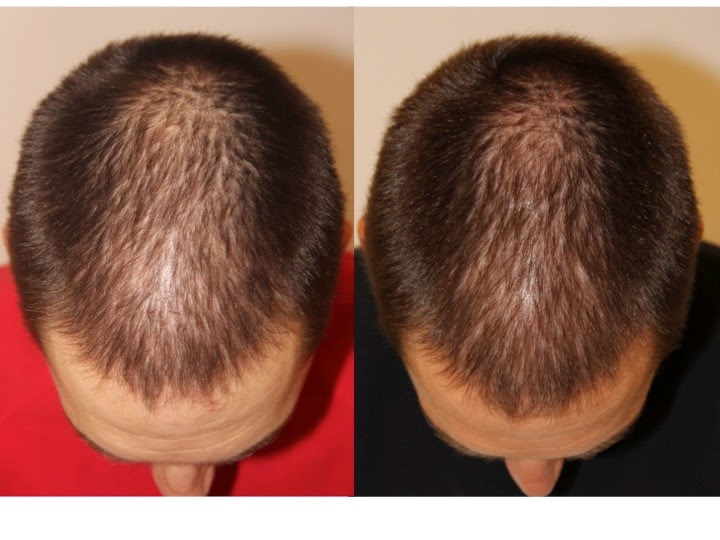 Is Prp Effective For Treating Hair Loss Dr Jeffrey