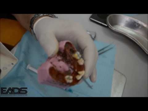 composite class V & III by Dr Mohamed Abd-Elmoty-NUB
