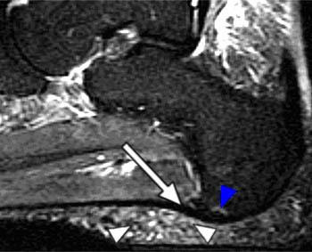 Plantar Fasciitis - Radsource