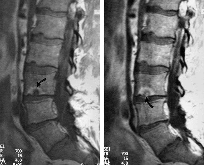Relationship Of Schmorl S Nodes To Vertebral Body Endplate Fractures And Acute Endplate Disk Extrusions American Journal Of Neuroradiology