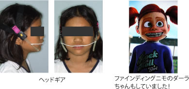 上顎前突 出っ歯 成長期の治療 治療例 ユニ矯正歯科クリニック 札幌市琴似にある 矯正専門の歯科医院です