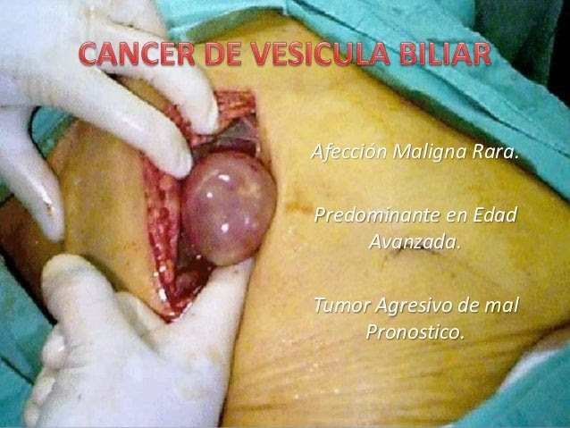 Cancer de vesicula biliar.pptx expo fer Cancer de vesicula biliar.pptx expo fer