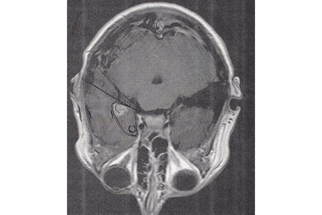 brainscan