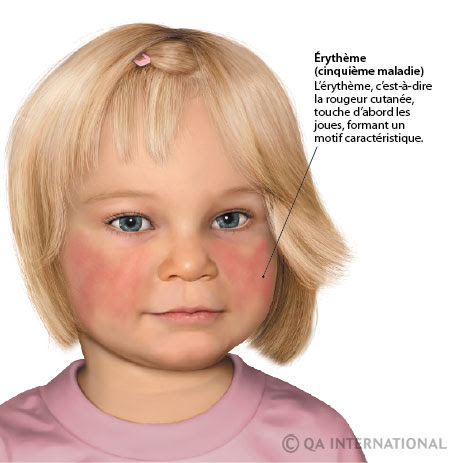 Les Maladies Infectieuses De L Enfant La Prevention Avant Tout 2e Partie Dictionnaire Visuel