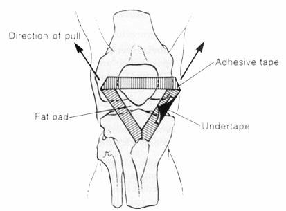 Tape In The Management Of Patellofemoral Pain Claire Patella