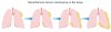 Mesothelioma Cancer Of Lung - What Causes Mesothelioma Cancer: How You Get It & Risk Factors