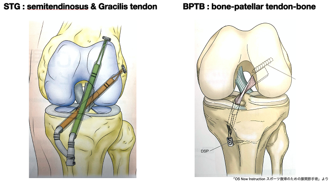 前十字靭帯損傷の治療 堀江病院