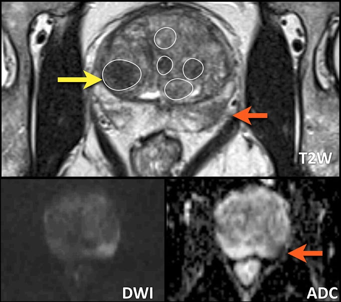 Prostate Cancer Zone - The Radiology Assistant : Prostate Cancer - PI-RADS v2 - Find the information you need today.