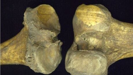 knee arthritis 