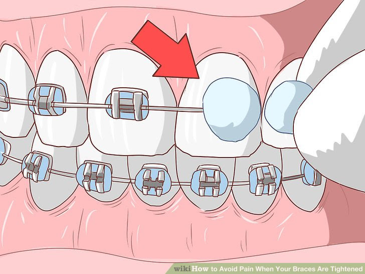 Avoid Pain When Your Braces Are Tightened Step 13.jpg