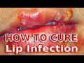Home Care For Lip Infection - Home Remedy