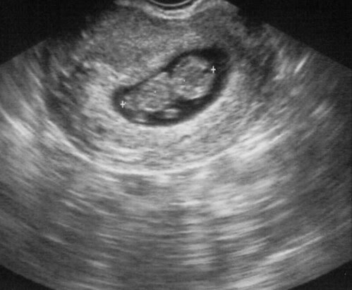 Ultrasound #1