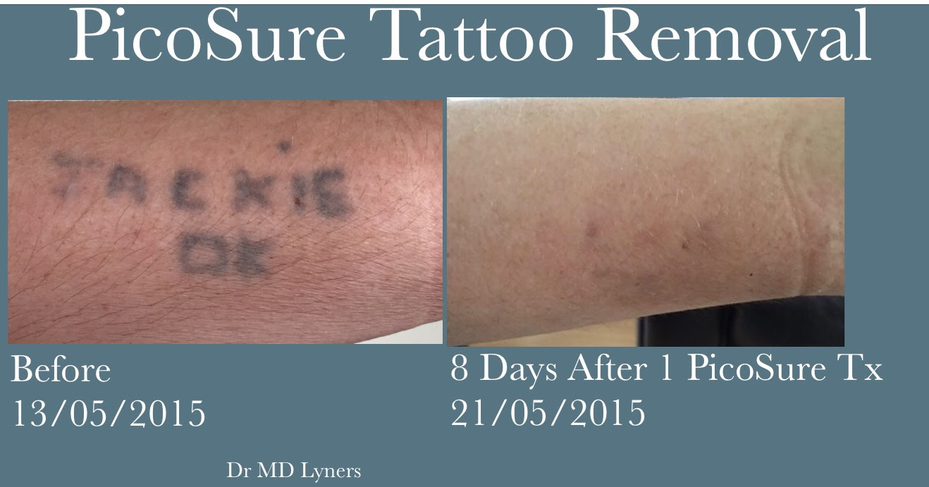 The PicoSure Advantage vs Q-switched Nd:YAG lasers