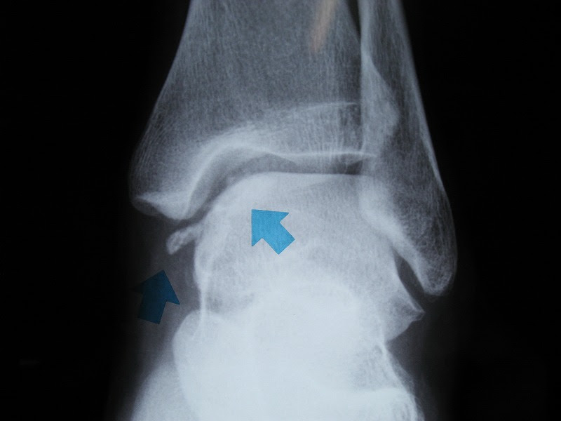 こまっちゅう患者さん 関節ねずみ もりもと整形外科 内科