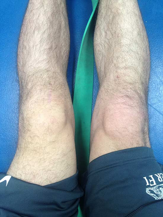 Tenth Month Acl Reconstruction Surgery Recovery