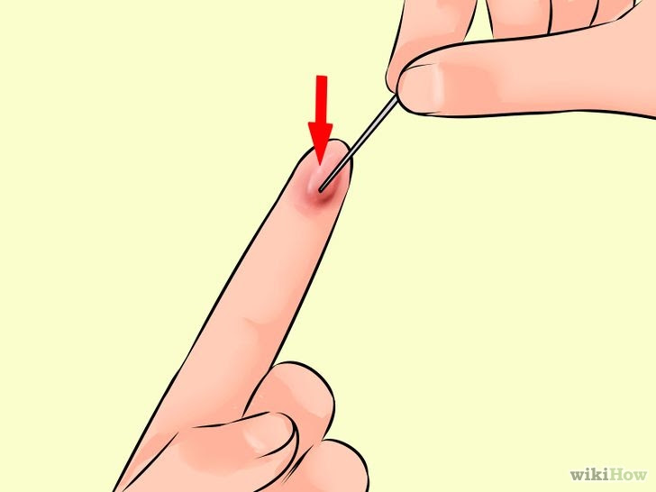 Treat a Blood Blister Step 10.jpg