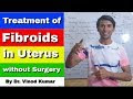 ਸਰਜਰੀ ਤੋਂ ਬਿਨਾਂ ਬੱਚੇਦਾਨੀ ਵਿੱਚ ਫਾਈਬਰੋਇਡਜ਼ ਦਾ ਇਲਾਜ