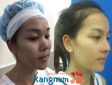 Nâng mũi S-line sụn sườn dành cho đối tượng nào? 1