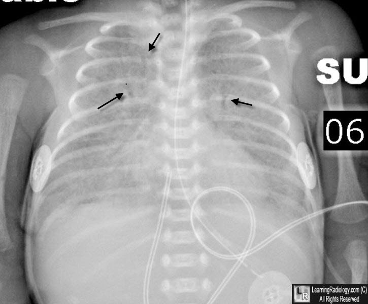 Learningradiology Respiratory Distress Syndrome Of The Newborn Hyaline Membrane Disease