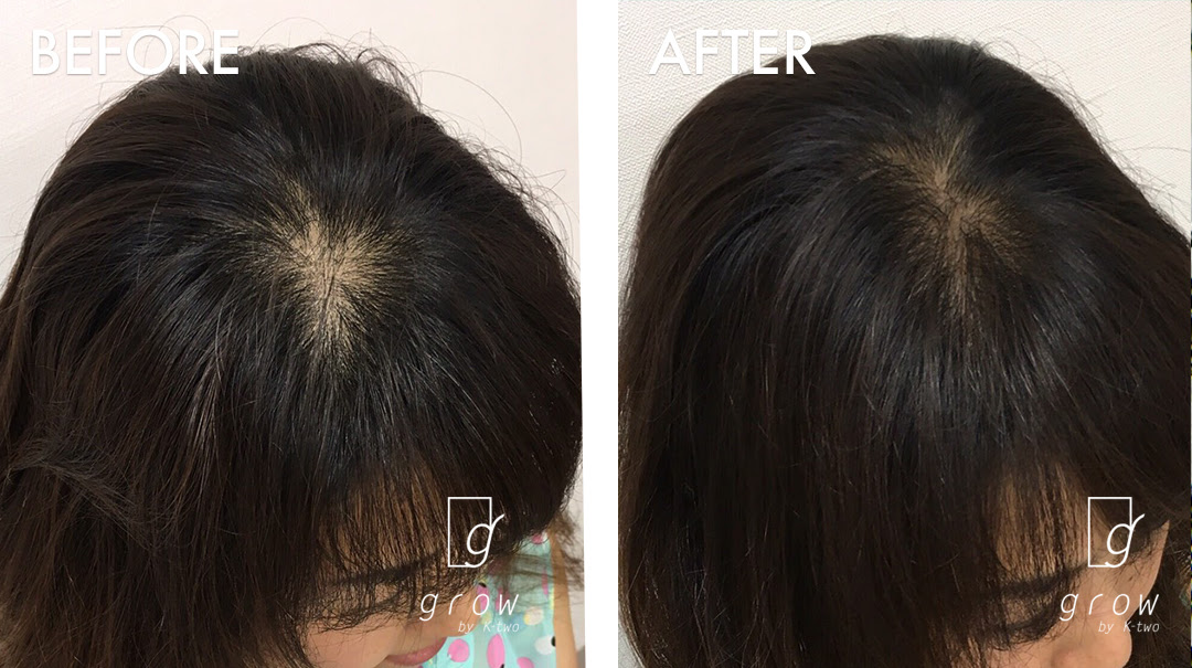 地肌の透け感が気になる 発毛育毛サロン Grow By K Two