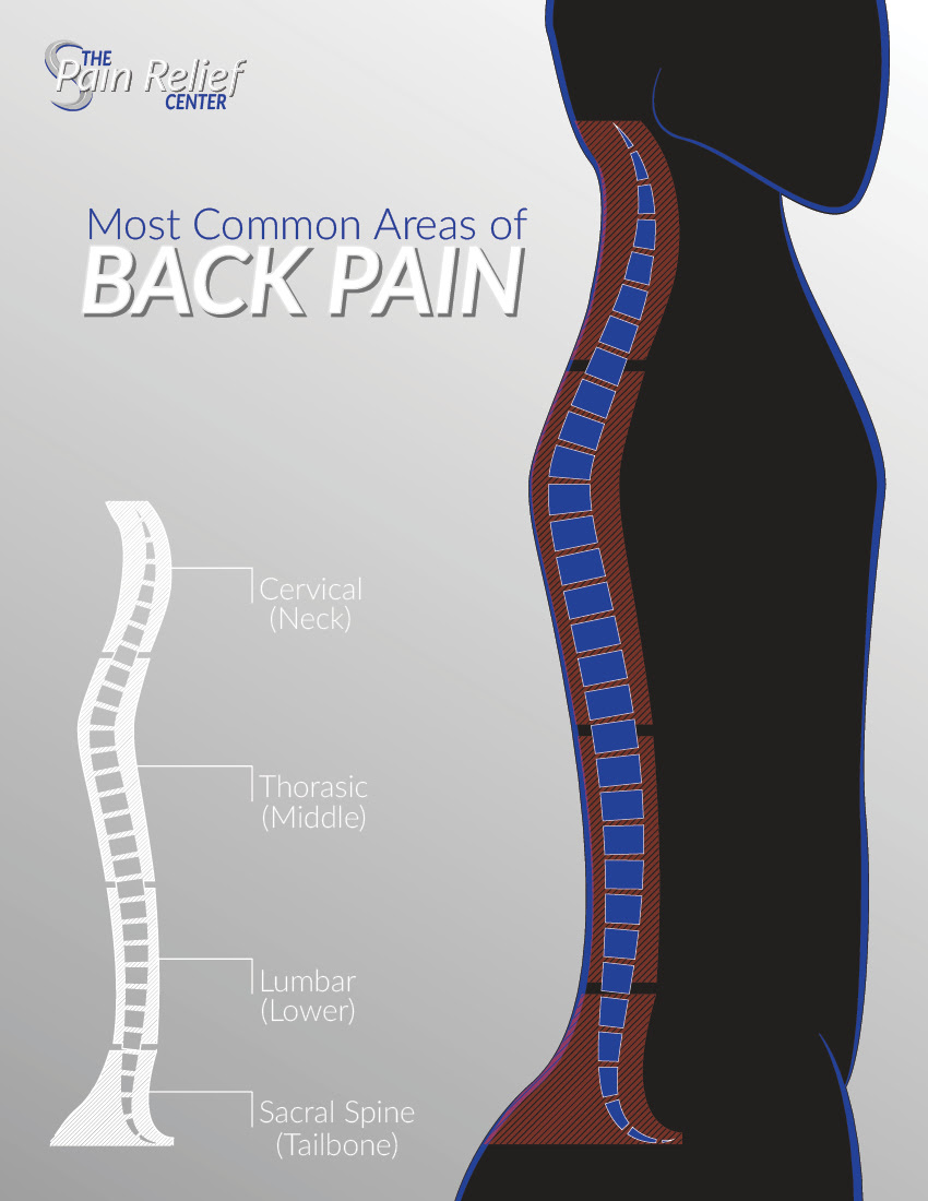 Most Common Back Pain Areas