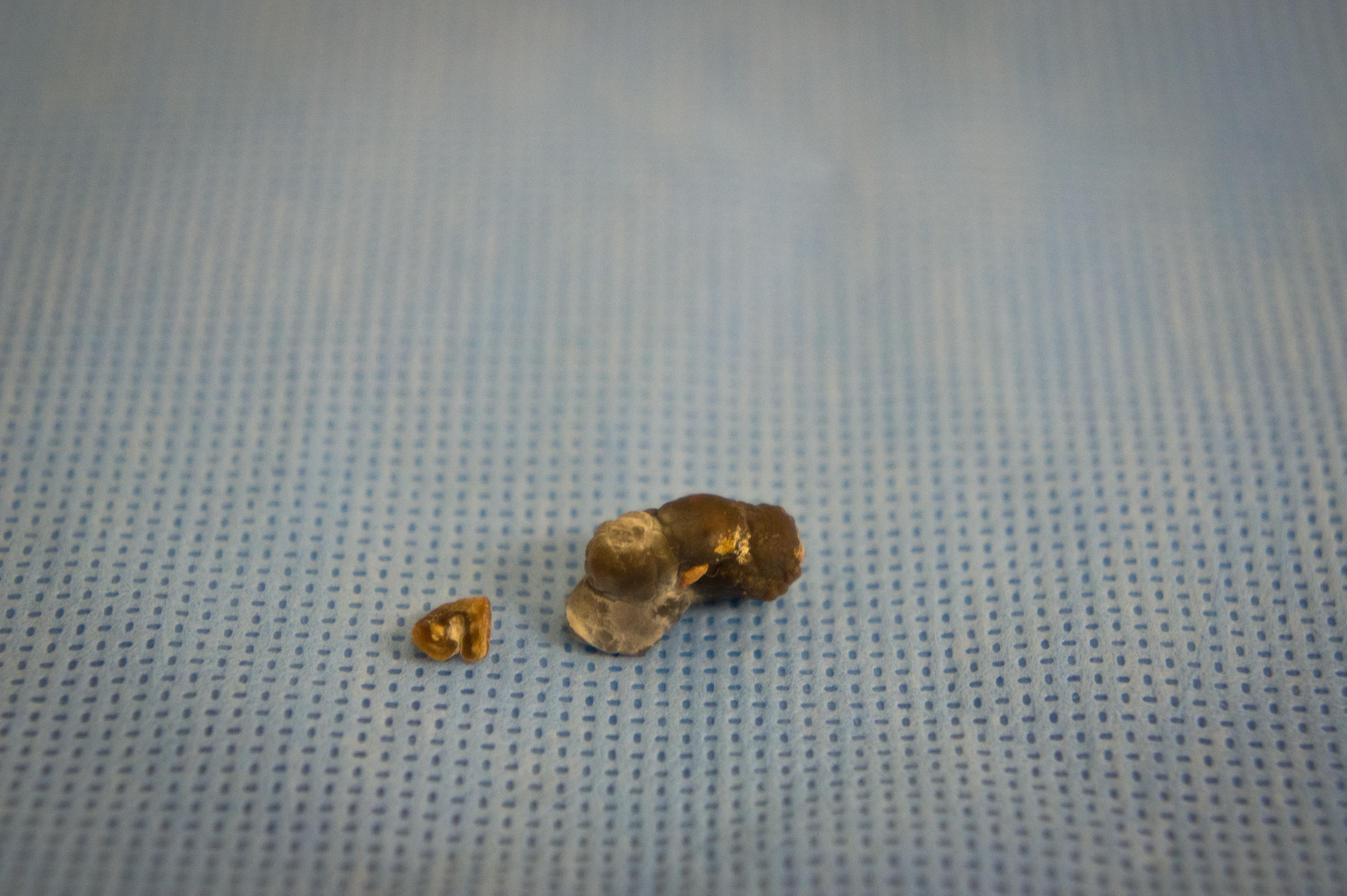 4mm Kidney Stone Picture - Kidney Failure Disease