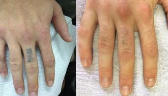 ... IPL hair removal beauty salon Toowoomba: Laser Tattoo Removal