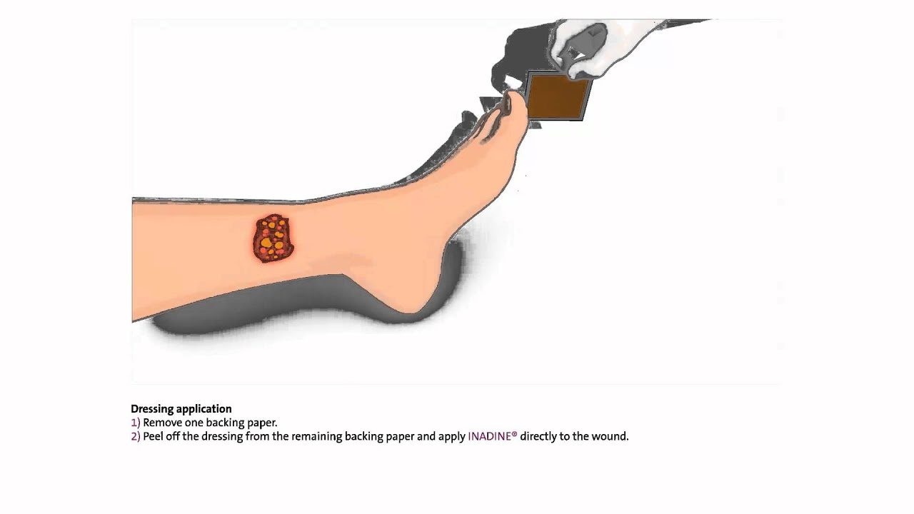 When and how to use iodine dressings Nursing Times