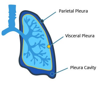 Pleural Mesothelioma Types / Pleural Mesothelioma Stages Treatment Prognosis : This type is called pleural mesothelioma.