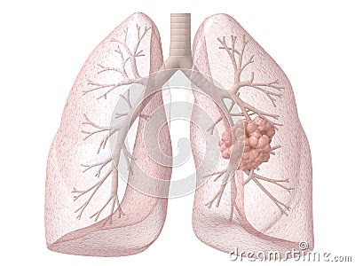 |Life expectancy cancer in