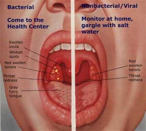 tonsillitistonsillectomy tonsils infection kavielteo main