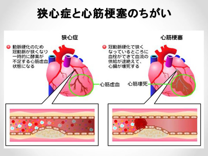 狭心症 心筋梗塞の予防と最新治療 あなたも発症予備軍かも らくわ健康教室 講演録