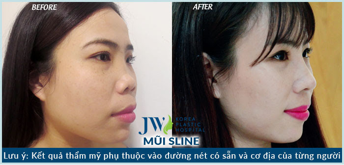 Nâng mũi S line sụn sườn