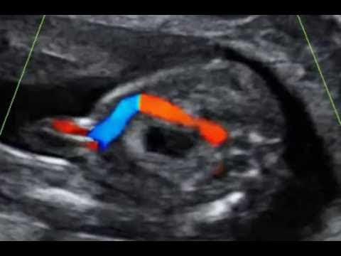 Video O CordãO Umbilical Tem Quantas Arterias