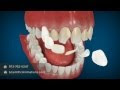 Cosmetic Dentistry Procedures - Dental Animation