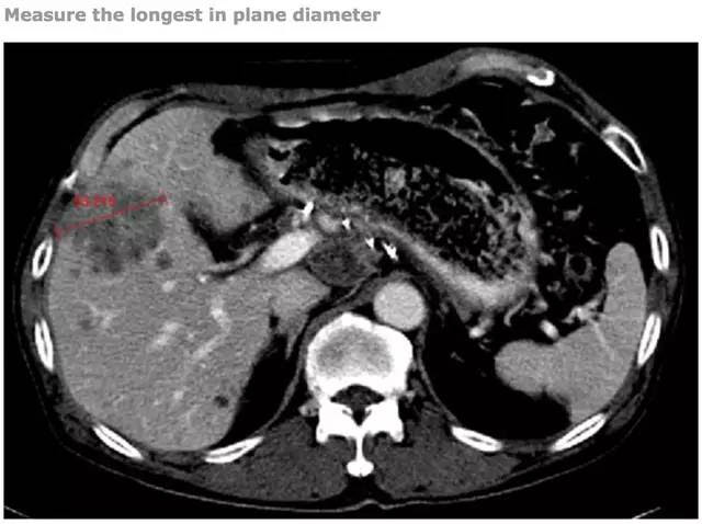 Recist 标准 肿瘤治疗评价的基石