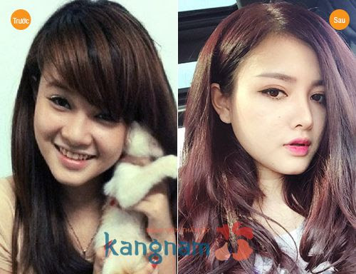 Địa chỉ nâng mũi S-line đẹp 6