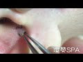  This Deep Blackhead Being Removed from a Man’s Ear May Be the Most Satisfying Video You’ll See Today