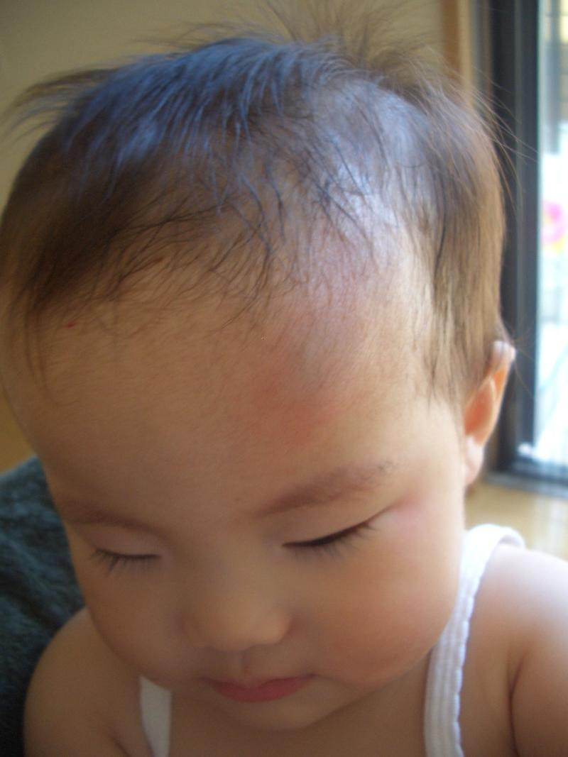 たんこぶ赤ちゃん あこやん日記