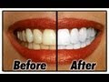 Formas de Blanquear Tus Dientes Naturalmente